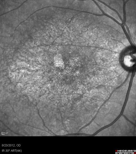 Macular possible Cone Dystrophy - Infra-red
