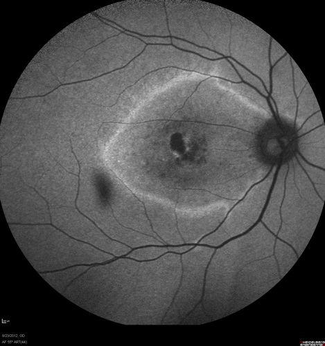 Macular possible Cone Dystrophy - Fundus Autofluorescence
