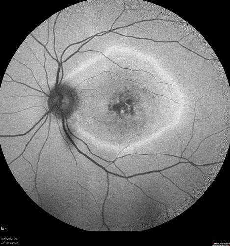 Macular possible Cone Dystrophy - Fundus Autofluorescence
