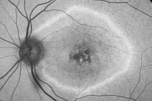 Macular possible Cone Dystrophy - Fundus Autofluorescence
