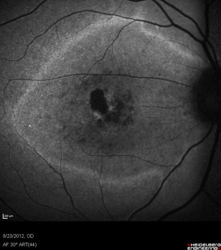 Macular possible Cone Dystrophy - Fundus Autofluorescence

