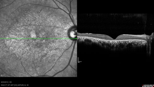 Macular possible Cone Dystrophy - SD-OCT
