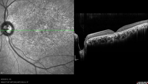 Macular possible Cone Dystrophy - SD-OCT
