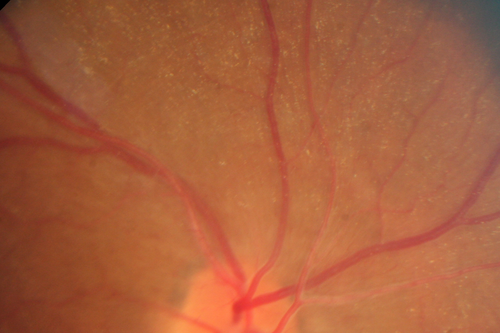 Retinitis Pigmentosa Sine Pigmento or Unknown Dystrophy - Peripheral Superficial White Spots and Recurrent CME
46-year-old woman three of her 5 siblings have been diagnosed with retinitis pigmentosa.  Her mother and father were seen and as far as everyone can tell, neither of them has it, although there was some thought they might be carriers.  They were evaluated twenty five years ago and since then as far as she knows, there has not been a lot of testing done.  

She has noticed a substantial decline in vision in both eyes over the last month or two.   OD 20/40,  OS 20/50.   IOP:  Both eyes have CME
