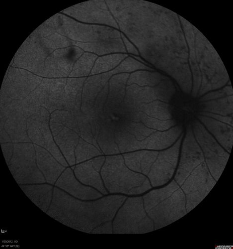 Retinitis Pigmentosa Sine Pigmento or Unknown Dystrophy - Peripheral Superficial White Spots and Recurrent CME - FAF
46-year-old woman three of her 5 siblings have been diagnosed with retinitis pigmentosa.  Her mother and father were seen and as far as everyone can tell, neither of them has it, although there was some thought they might be carriers.  They were evaluated twenty five years ago and since then as far as she knows, there has not been a lot of testing done.  

She has noticed a substantial decline in vision in both eyes over the last month or two.   OD 20/40,  OS 20/50.   IOP:  Both eyes have CME
