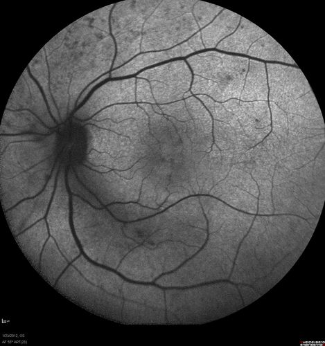 Retinitis Pigmentosa Sine Pigmento or Unknown Dystrophy - Peripheral Superficial White Spots and Recurrent CME - FAF
46-year-old woman three of her 5 siblings have been diagnosed with retinitis pigmentosa.  Her mother and father were seen and as far as everyone can tell, neither of them has it, although there was some thought they might be carriers.  They were evaluated twenty five years ago and since then as far as she knows, there has not been a lot of testing done.  

She has noticed a substantial decline in vision in both eyes over the last month or two.   OD 20/40,  OS 20/50.   IOP:  Both eyes have CME

