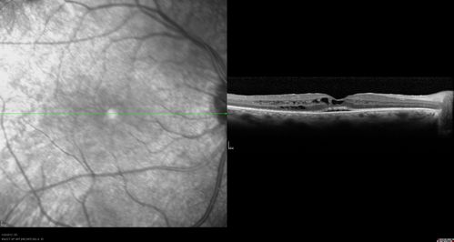 Retinitis Pigmentosa Sine Pigmento or Unknown Dystrophy - Peripheral Superficial White Spots and Recurrent CME
46-year-old woman three of her 5 siblings have been diagnosed with retinitis pigmentosa.  Her mother and father were seen and as far as everyone can tell, neither of them has it, although there was some thought they might be carriers.  They were evaluated twenty five years ago and since then as far as she knows, there has not been a lot of testing done.  

She has noticed a substantial decline in vision in both eyes over the last month or two.   OD 20/40,  OS 20/50.   IOP:  Both eyes have CME
