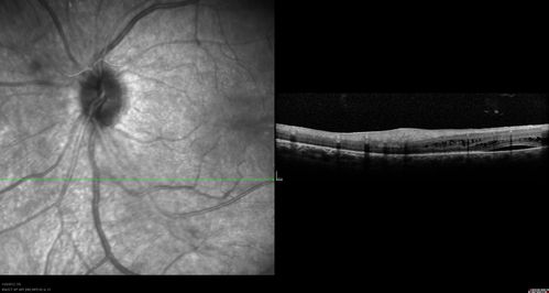 Retinitis Pigmentosa Sine Pigmento or Unknown Dystrophy - Peripheral Superficial White Spots and Recurrent CME
46-year-old woman three of her 5 siblings have been diagnosed with retinitis pigmentosa.  Her mother and father were seen and as far as everyone can tell, neither of them has it, although there was some thought they might be carriers.  They were evaluated twenty five years ago and since then as far as she knows, there has not been a lot of testing done.  

She has noticed a substantial decline in vision in both eyes over the last month or two.   OD 20/40,  OS 20/50.   IOP:  Both eyes have CME
