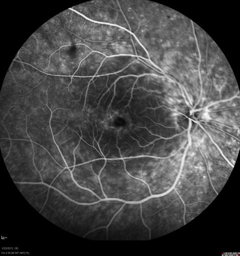 Retinitis Pigmentosa Sine Pigmento or Unknown Dystrophy - Peripheral Superficial White Spots and Recurrent CME - FA Early
46-year-old woman three of her 5 siblings have been diagnosed with retinitis pigmentosa.  Her mother and father were seen and as far as everyone can tell, neither of them has it, although there was some thought they might be carriers.  They were evaluated twenty five years ago and since then as far as she knows, there has not been a lot of testing done.  

She has noticed a substantial decline in vision in both eyes over the last month or two.   OD 20/40,  OS 20/50.   IOP:  Both eyes have CME
