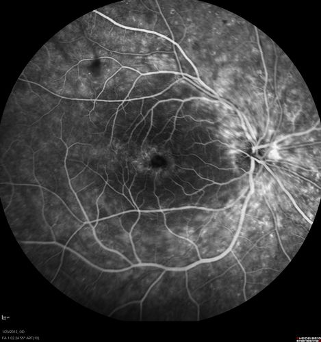 Retinitis Pigmentosa Sine Pigmento or Unknown Dystrophy - Peripheral Superficial White Spots and Recurrent CME - FA Early
46-year-old woman three of her 5 siblings have been diagnosed with retinitis pigmentosa.  Her mother and father were seen and as far as everyone can tell, neither of them has it, although there was some thought they might be carriers.  They were evaluated twenty five years ago and since then as far as she knows, there has not been a lot of testing done.  

She has noticed a substantial decline in vision in both eyes over the last month or two.   OD 20/40,  OS 20/50.   IOP:  Both eyes have CME
