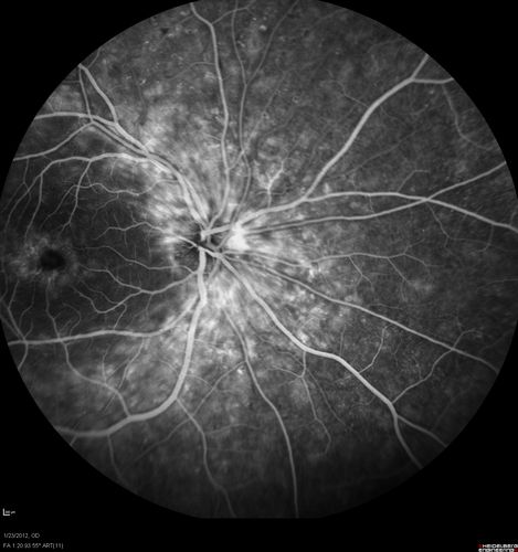 Retinitis Pigmentosa Sine Pigmento or Unknown Dystrophy - Peripheral Superficial White Spots and Recurrent CME - FA Early
46-year-old woman three of her 5 siblings have been diagnosed with retinitis pigmentosa.  Her mother and father were seen and as far as everyone can tell, neither of them has it, although there was some thought they might be carriers.  They were evaluated twenty five years ago and since then as far as she knows, there has not been a lot of testing done.  

She has noticed a substantial decline in vision in both eyes over the last month or two.   OD 20/40,  OS 20/50.   IOP:  Both eyes have CME
