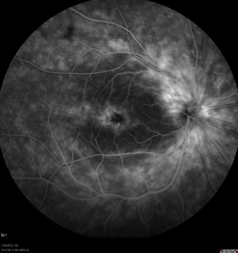 Retinitis Pigmentosa Sine Pigmento or Unknown Dystrophy - Peripheral Superficial White Spots and Recurrent CME - FA MID
46-year-old woman three of her 5 siblings have been diagnosed with retinitis pigmentosa.  Her mother and father were seen and as far as everyone can tell, neither of them has it, although there was some thought they might be carriers.  They were evaluated twenty five years ago and since then as far as she knows, there has not been a lot of testing done.  

She has noticed a substantial decline in vision in both eyes over the last month or two.   OD 20/40,  OS 20/50.   IOP:  Both eyes have CME
