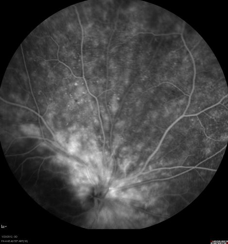 Retinitis Pigmentosa Sine Pigmento or Unknown Dystrophy - Peripheral Superficial White Spots and Recurrent CME - FA MID
46-year-old woman three of her 5 siblings have been diagnosed with retinitis pigmentosa.  Her mother and father were seen and as far as everyone can tell, neither of them has it, although there was some thought they might be carriers.  They were evaluated twenty five years ago and since then as far as she knows, there has not been a lot of testing done.  

She has noticed a substantial decline in vision in both eyes over the last month or two.   OD 20/40,  OS 20/50.   IOP:  Both eyes have CME
