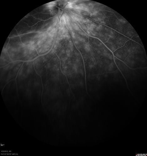 Retinitis Pigmentosa Sine Pigmento or Unknown Dystrophy - Peripheral Superficial White Spots and Recurrent CME - FA LATE
46-year-old woman three of her 5 siblings have been diagnosed with retinitis pigmentosa.  Her mother and father were seen and as far as everyone can tell, neither of them has it, although there was some thought they might be carriers.  They were evaluated twenty five years ago and since then as far as she knows, there has not been a lot of testing done.  

She has noticed a substantial decline in vision in both eyes over the last month or two.   OD 20/40,  OS 20/50.   IOP:  Both eyes have CME
