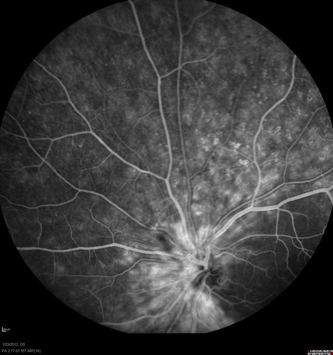 Retinitis Pigmentosa Sine Pigmento or Unknown Dystrophy - Peripheral Superficial White Spots and Recurrent CME - FA Early
46-year-old woman three of her 5 siblings have been diagnosed with retinitis pigmentosa.  Her mother and father were seen and as far as everyone can tell, neither of them has it, although there was some thought they might be carriers.  They were evaluated twenty five years ago and since then as far as she knows, there has not been a lot of testing done.  

She has noticed a substantial decline in vision in both eyes over the last month or two.   OD 20/40,  OS 20/50.   IOP:  Both eyes have CME
