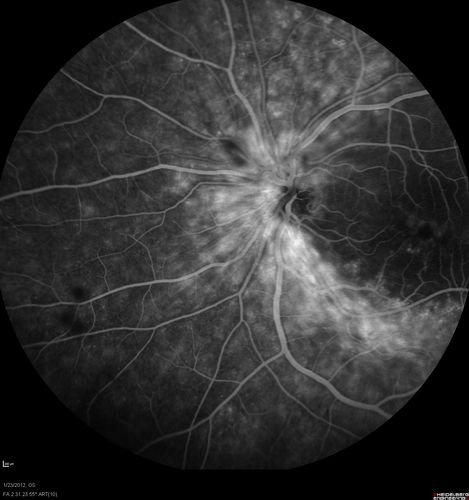 Retinitis Pigmentosa Sine Pigmento or Unknown Dystrophy - Peripheral Superficial White Spots and Recurrent CME - FA Early
46-year-old woman three of her 5 siblings have been diagnosed with retinitis pigmentosa.  Her mother and father were seen and as far as everyone can tell, neither of them has it, although there was some thought they might be carriers.  They were evaluated twenty five years ago and since then as far as she knows, there has not been a lot of testing done.  

She has noticed a substantial decline in vision in both eyes over the last month or two.   OD 20/40,  OS 20/50.   IOP:  Both eyes have CME
