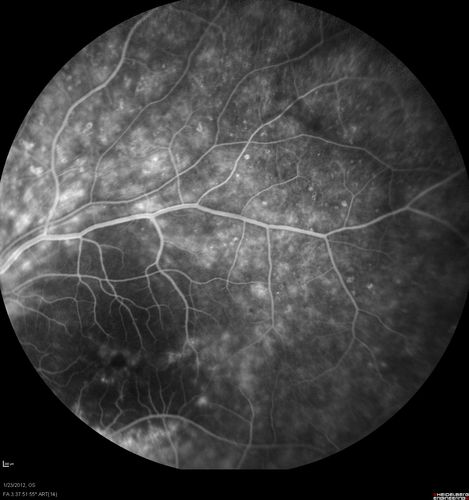 Retinitis Pigmentosa Sine Pigmento or Unknown Dystrophy - Peripheral Superficial White Spots and Recurrent CME
46-year-old woman three of her 5 siblings have been diagnosed with retinitis pigmentosa.  Her mother and father were seen and as far as everyone can tell, neither of them has it, although there was some thought they might be carriers.  They were evaluated twenty five years ago and since then as far as she knows, there has not been a lot of testing done.  

She has noticed a substantial decline in vision in both eyes over the last month or two.   OD 20/40,  OS 20/50.   IOP:  Both eyes have CME
