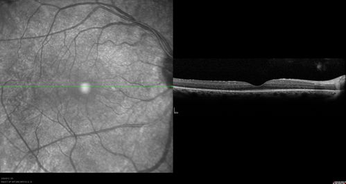Retinitis Pigmentosa Sine Pigmento or Unknown Dystrophy - Peripheral Superficial White Spots and Recurrent CME
1 month of treatment with diamox 500 mg BID- cme is a little better
