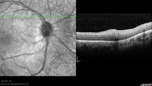 Retinitis Pigmentosa Sine Pigmento or Unknown Dystrophy - Peripheral Superficial White Spots and Recurrent CME
1 month of treatment with diamox 500 mg BID- cme is a little better
