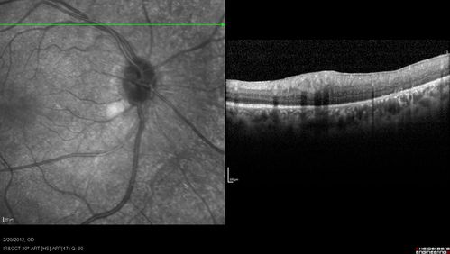 Retinitis Pigmentosa Sine Pigmento or Unknown Dystrophy - Peripheral Superficial White Spots and Recurrent CME
1 month of treatment with diamox 500 mg BID- cme is a little better
