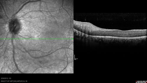 Retinitis Pigmentosa Sine Pigmento or Unknown Dystrophy - Peripheral Superficial White Spots and Recurrent CME
1 month of treatment with diamox 500 mg BID- cme is a little better
