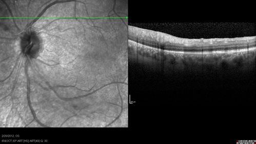 Retinitis Pigmentosa Sine Pigmento or Unknown Dystrophy - Peripheral Superficial White Spots and Recurrent CME
1 month of treatment with diamox 500 mg BID- cme is a little better
