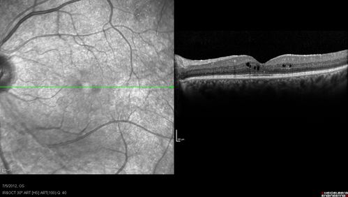 Retinitis Pigmentosa Sine Pigmento or Unknown Dystrophy - Peripheral Superficial White Spots and Recurrent CME
Subtenon's Kenlalog given right eye today.
