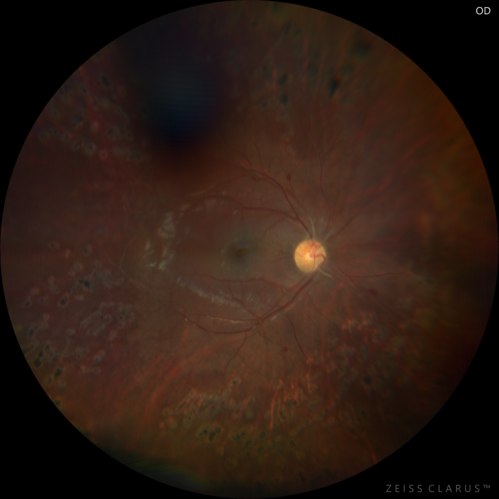 Eales Disease and fresh vitreous hemorrhage - 20 year old man
20 year old mane with fresh vitreous hemorrhage in the right eye.  At age 15 he had a PPV and laser in the left eye and laser in the right eye.  The vision is OD 20/80 PH 20/25, OS 20/25.  The left eye has a mild cataract.  He had prior testing for coagulopathies which was negative.  Testing done for syphillis and TB was negative.  Additional laser was done to prevent further bleeding in the right eye.
