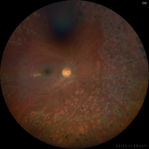 Eales Disease and fresh vitreous hemorrhage - 20 year old man
20 year old mane with fresh vitreous hemorrhage in the right eye.  At age 15 he had a PPV and laser in the left eye and laser in the right eye.  The vision is OD 20/80 PH 20/25, OS 20/25.  The left eye has a mild cataract.  He had prior testing for coagulopathies which was negative.  Testing done for syphillis and TB was negative.  Additional laser was done to prevent further bleeding in the right eye.

