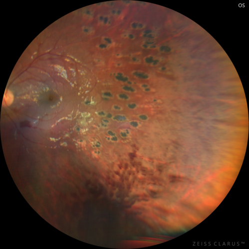 Eales Disease and fresh vitreous hemorrhage - 20 year old man
20 year old mane with fresh vitreous hemorrhage in the right eye.  At age 15 he had a PPV and laser in the left eye and laser in the right eye.  The vision is OD 20/80 PH 20/25, OS 20/25.  The left eye has a mild cataract.  He had prior testing for coagulopathies which was negative.  Testing done for syphillis and TB was negative.  Additional laser was done to prevent further bleeding in the right eye.
