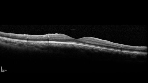 Eales Disease and fresh vitreous hemorrhage - 20 year old man
20 year old mane with fresh vitreous hemorrhage in the right eye.  At age 15 he had a PPV and laser in the left eye and laser in the right eye.  The vision is OD 20/80 PH 20/25, OS 20/25.  The left eye has a mild cataract.  He had prior testing for coagulopathies which was negative.  Testing done for syphillis and TB was negative.  Additional laser was done to prevent further bleeding in the right eye.
