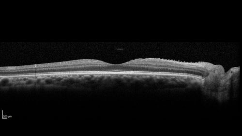 Eales Disease and fresh vitreous hemorrhage - 20 year old man
20 year old mane with fresh vitreous hemorrhage in the right eye.  At age 15 he had a PPV and laser in the left eye and laser in the right eye.  The vision is OD 20/80 PH 20/25, OS 20/25.  The left eye has a mild cataract.  He had prior testing for coagulopathies which was negative.  Testing done for syphillis and TB was negative.  Additional laser was done to prevent further bleeding in the right eye.
