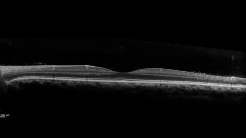 Eales Disease and fresh vitreous hemorrhage - 20 year old man
20 year old mane with fresh vitreous hemorrhage in the right eye.  At age 15 he had a PPV and laser in the left eye and laser in the right eye.  The vision is OD 20/80 PH 20/25, OS 20/25.  The left eye has a mild cataract.  He had prior testing for coagulopathies which was negative.  Testing done for syphillis and TB was negative.  Additional laser was done to prevent further bleeding in the right eye.
