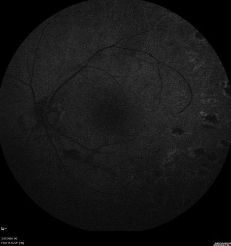 Eales Disease and fresh vitreous hemorrhage - 20 year old man
20 year old mane with fresh vitreous hemorrhage in the right eye.  At age 15 he had a PPV and laser in the left eye and laser in the right eye.  The vision is OD 20/80 PH 20/25, OS 20/25.  The left eye has a mild cataract.  He had prior testing for coagulopathies which was negative.  Testing done for syphillis and TB was negative.  Additional laser was done to prevent further bleeding in the right eye.
