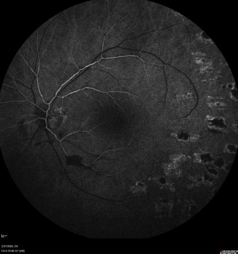 Eales Disease and fresh vitreous hemorrhage - 20 year old man
20 year old mane with fresh vitreous hemorrhage in the right eye.  At age 15 he had a PPV and laser in the left eye and laser in the right eye.  The vision is OD 20/80 PH 20/25, OS 20/25.  The left eye has a mild cataract.  He had prior testing for coagulopathies which was negative.  Testing done for syphillis and TB was negative.  Additional laser was done to prevent further bleeding in the right eye.
