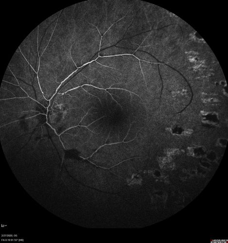 Eales Disease and fresh vitreous hemorrhage - 20 year old man
20 year old mane with fresh vitreous hemorrhage in the right eye.  At age 15 he had a PPV and laser in the left eye and laser in the right eye.  The vision is OD 20/80 PH 20/25, OS 20/25.  The left eye has a mild cataract.  He had prior testing for coagulopathies which was negative.  Testing done for syphillis and TB was negative.  Additional laser was done to prevent further bleeding in the right eye.
