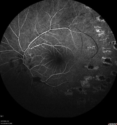 Eales Disease and fresh vitreous hemorrhage - 20 year old man
20 year old mane with fresh vitreous hemorrhage in the right eye.  At age 15 he had a PPV and laser in the left eye and laser in the right eye.  The vision is OD 20/80 PH 20/25, OS 20/25.  The left eye has a mild cataract.  He had prior testing for coagulopathies which was negative.  Testing done for syphillis and TB was negative.  Additional laser was done to prevent further bleeding in the right eye.
