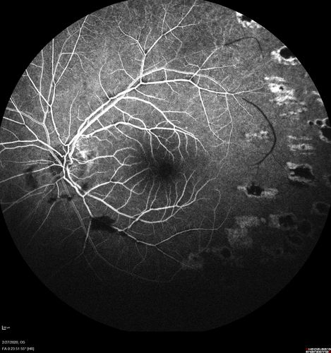 Eales Disease and fresh vitreous hemorrhage - 20 year old man
20 year old mane with fresh vitreous hemorrhage in the right eye.  At age 15 he had a PPV and laser in the left eye and laser in the right eye.  The vision is OD 20/80 PH 20/25, OS 20/25.  The left eye has a mild cataract.  He had prior testing for coagulopathies which was negative.  Testing done for syphillis and TB was negative.  Additional laser was done to prevent further bleeding in the right eye.

