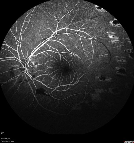 Eales Disease and fresh vitreous hemorrhage - 20 year old man
20 year old mane with fresh vitreous hemorrhage in the right eye.  At age 15 he had a PPV and laser in the left eye and laser in the right eye.  The vision is OD 20/80 PH 20/25, OS 20/25.  The left eye has a mild cataract.  He had prior testing for coagulopathies which was negative.  Testing done for syphillis and TB was negative.  Additional laser was done to prevent further bleeding in the right eye.
