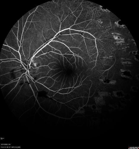 Eales Disease and fresh vitreous hemorrhage - 20 year old man
20 year old mane with fresh vitreous hemorrhage in the right eye.  At age 15 he had a PPV and laser in the left eye and laser in the right eye.  The vision is OD 20/80 PH 20/25, OS 20/25.  The left eye has a mild cataract.  He had prior testing for coagulopathies which was negative.  Testing done for syphillis and TB was negative.  Additional laser was done to prevent further bleeding in the right eye.

