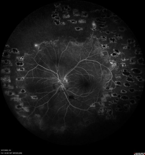 Eales Disease and fresh vitreous hemorrhage - 20 year old man
20 year old mane with fresh vitreous hemorrhage in the right eye.  At age 15 he had a PPV and laser in the left eye and laser in the right eye.  The vision is OD 20/80 PH 20/25, OS 20/25.  The left eye has a mild cataract.  He had prior testing for coagulopathies which was negative.  Testing done for syphillis and TB was negative.  Additional laser was done to prevent further bleeding in the right eye.
