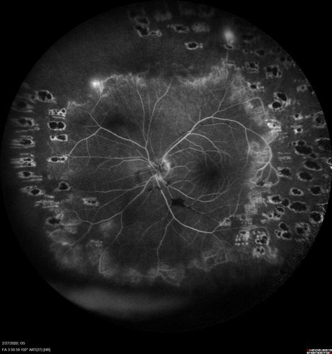 Eales Disease and fresh vitreous hemorrhage - 20 year old man
20 year old mane with fresh vitreous hemorrhage in the right eye.  At age 15 he had a PPV and laser in the left eye and laser in the right eye.  The vision is OD 20/80 PH 20/25, OS 20/25.  The left eye has a mild cataract.  He had prior testing for coagulopathies which was negative.  Testing done for syphillis and TB was negative.  Additional laser was done to prevent further bleeding in the right eye.
