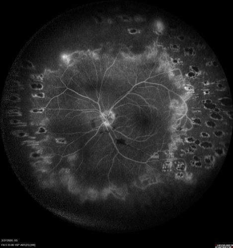 Eales Disease and fresh vitreous hemorrhage - 20 year old man
20 year old mane with fresh vitreous hemorrhage in the right eye.  At age 15 he had a PPV and laser in the left eye and laser in the right eye.  The vision is OD 20/80 PH 20/25, OS 20/25.  The left eye has a mild cataract.  He had prior testing for coagulopathies which was negative.  Testing done for syphillis and TB was negative.  Additional laser was done to prevent further bleeding in the right eye.
