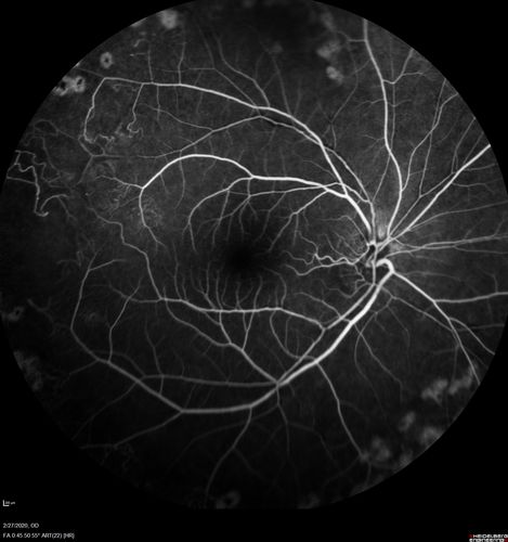 Eales Disease and fresh vitreous hemorrhage - 20 year old man
20 year old mane with fresh vitreous hemorrhage in the right eye.  At age 15 he had a PPV and laser in the left eye and laser in the right eye.  The vision is OD 20/80 PH 20/25, OS 20/25.  The left eye has a mild cataract.  He had prior testing for coagulopathies which was negative.  Testing done for syphillis and TB was negative.  Additional laser was done to prevent further bleeding in the right eye.
