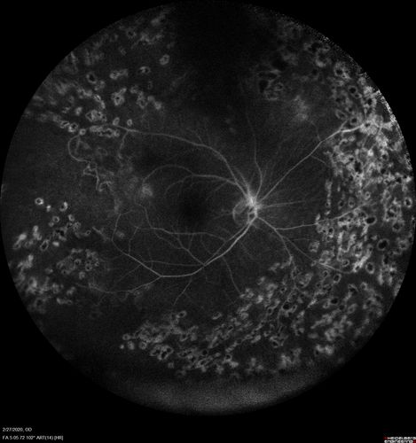 Eales Disease and fresh vitreous hemorrhage - 20 year old man
20 year old mane with fresh vitreous hemorrhage in the right eye.  At age 15 he had a PPV and laser in the left eye and laser in the right eye.  The vision is OD 20/80 PH 20/25, OS 20/25.  The left eye has a mild cataract.  He had prior testing for coagulopathies which was negative.  Testing done for syphillis and TB was negative.  Additional laser was done to prevent further bleeding in the right eye.
