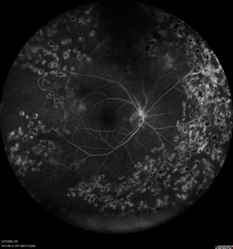 Eales Disease and fresh vitreous hemorrhage - 20 year old man
20 year old mane with fresh vitreous hemorrhage in the right eye.  At age 15 he had a PPV and laser in the left eye and laser in the right eye.  The vision is OD 20/80 PH 20/25, OS 20/25.  The left eye has a mild cataract.  He had prior testing for coagulopathies which was negative.  Testing done for syphillis and TB was negative.  Additional laser was done to prevent further bleeding in the right eye.
