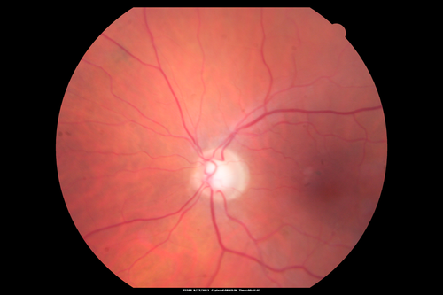 Peripheral Exudative Hemorrhagic Chorioretinopathy
70 year old man with recurrent peripheral choroidal hemorrhages - no treatment - b-scan shows hemorrhage shrinking over a month
