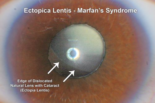 Ectopia Lentis and Cataract - Marfan's Syndrome
40-year-old woman has had dislocated lenses since she was a child.  The right eye is seeing well with an aphakic correction.  The left eye unfortunately has declining vision for 4 months.  OD 20/32,  OS 20/125.  Pinhole 20/50
