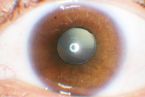 Ectopia Lentis and Cataract - Marfan's Syndrome
40-year-old woman has had dislocated lenses since she was a child.  The right eye is seeing well with an aphakic correction.  The left eye unfortunately has declining vision for 4 months.  OD 20/32,  OS 20/125.  Pinhole 20/50
