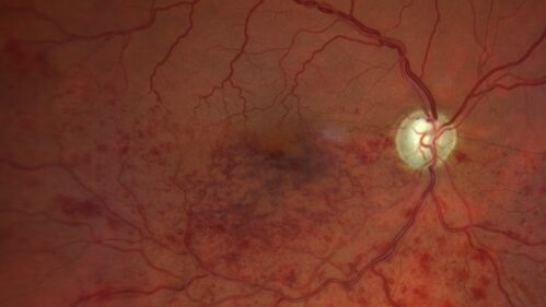 Branch Retinal Vein Occlusion and worsened cystoid macular edema following cataract surgery
51 year old female The patient noticed gradual vision loss in both eyes starting possibly after her last cataract surgery in May of 2022 (3 months ago). She had ECCE 3/2022 OD and 5/2022 OS.  She does not have diabetes. She had glaucoma shunts placed about 2017.  She has been on latanoprost and timolol.  She is now getting ready to start Combigan and Bromfenac.  She is also staring xidra for dry eye.  She stopped the latanorpost on 8/15/22.  She has had macular edema before for which she had intraocular injections which worked.  She has had no injections lately. When she was getting treated for macular edema in the past she had an IOP of 60. 
Medical Hx: Hypertension, Systemic. Glaucoma. Arthritis. Vertigo. Stroke. 
Systemic Meds: Trimfya. NAPROXEN. LISINOPRIL. 
VA OD: sc20/63-1 
VA OS: sc20/50 
IOP: TP: OD:12 OS:12
